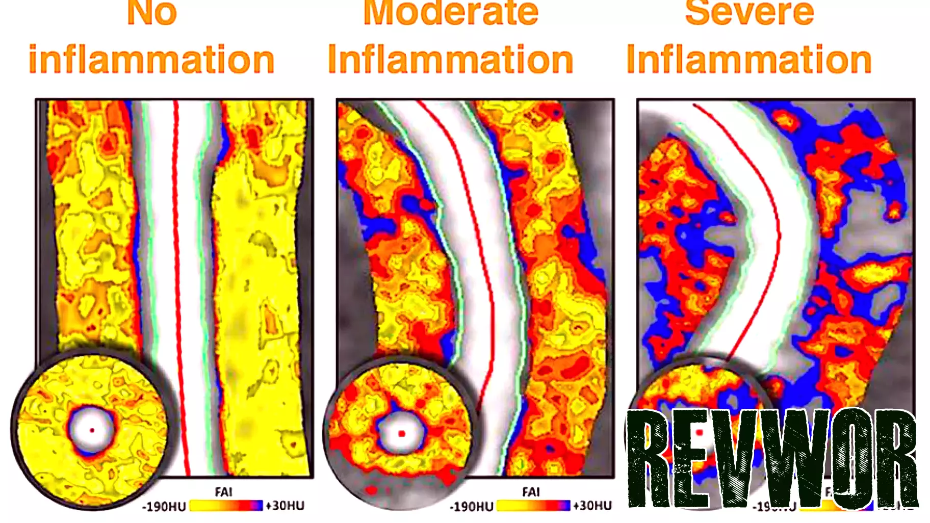 FDA authorizes first AI tech for visualizing coronary inflammation in CT scans