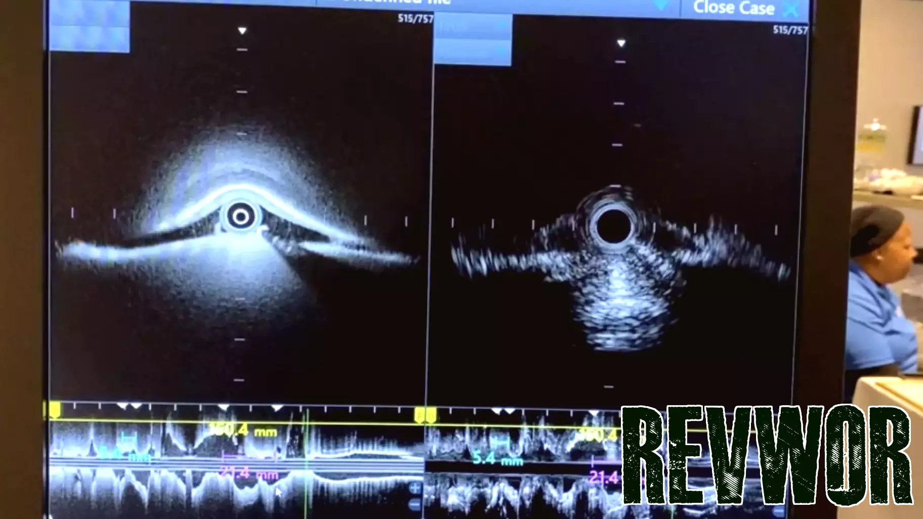 New York cardiologist performs first procedure in US with FDA-cleared imaging tech