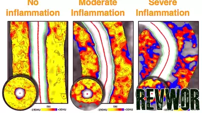 FDA authorizes first AI tech for visualizing coronary inflammation in CT scans